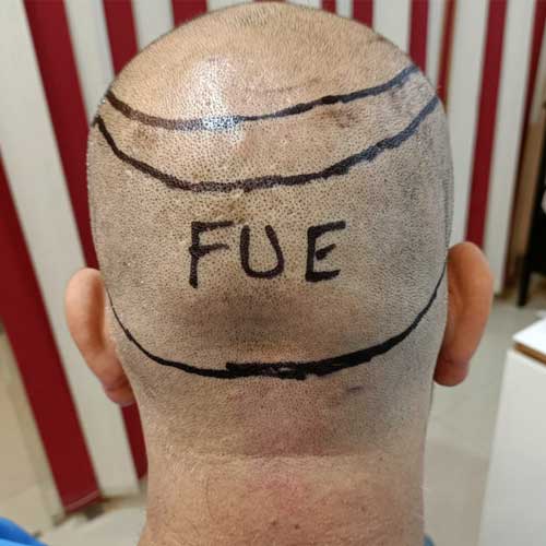 image of the Hair Transplant treatment